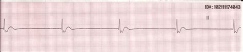 Float Nurse: EKG Rhythm Strips 17: Slow rhythms 1