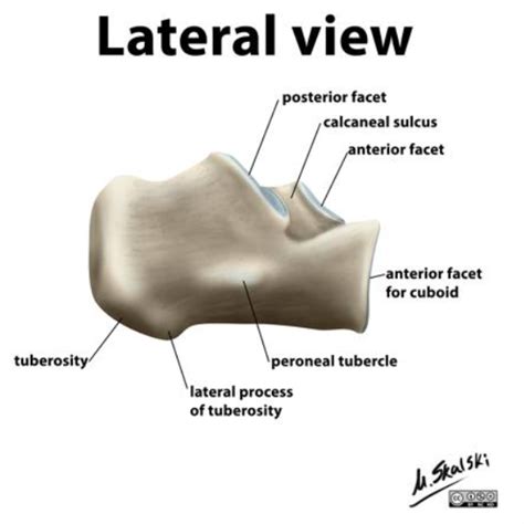 Calcaneus Fractures – Core EM