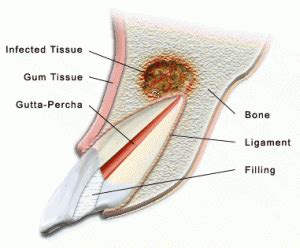 Apicoectomy Glenview IL, Oral Surgery of The Glen