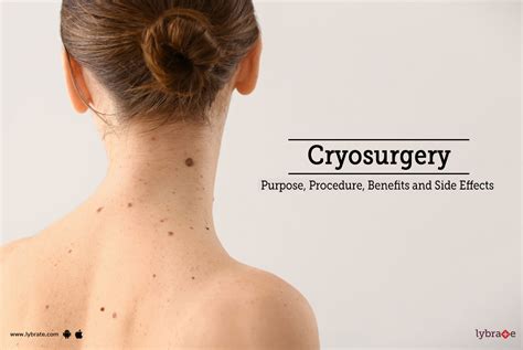 Cryosurgery: Purpose, Procedure, Benefits and Side Effects