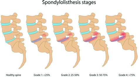 Spondylolysis Vs Spondylolisthesis