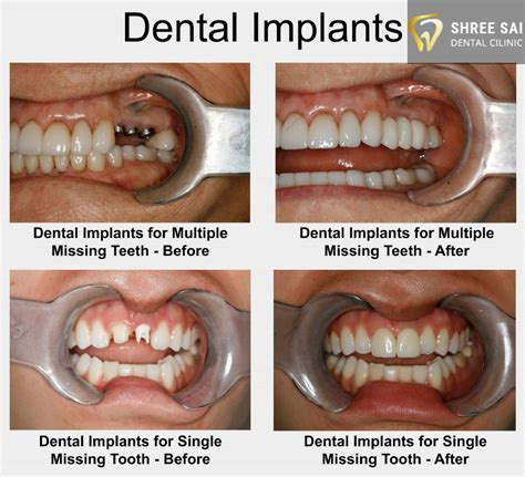 #toothfairytime #OralHealthTeeth | Dental implants, Tooth implant cost ...