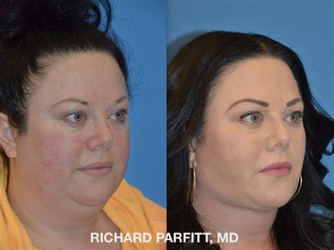 Dr. Parfitt of Madison WI performed Submental Liposuction for this woman to remove excess neck ...