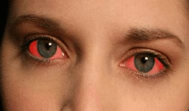 How to Make Your Eyes Red Fast: Bloodshot, to Look High, For a Long Time - Lightskincure