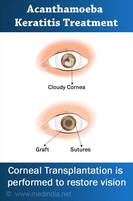 Acanthamoeba Corneal Ulcer