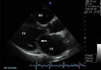 Parasternal long axis view. Thin akinetic posterior wall of the left... | Download Scientific ...