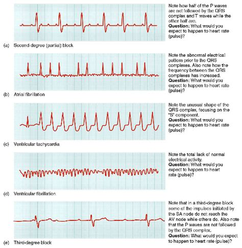 Cardiac Arrhythmia: Symptoms & Treatment | Study.com