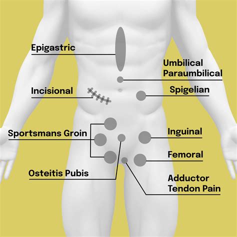 Hernia Types - The Hernia Clinic