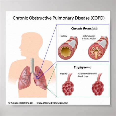 COPD Lung diseases diagram Poster | Zazzle.com