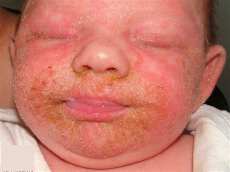 Infantile seborrheic dermatitis, causes, symptoms, diagnosis & treatment