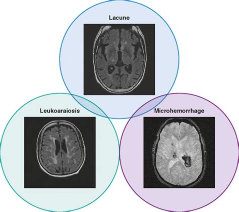 small vessel ischemic disease Cerebral csvd vascular svn bmj - Diseases Club Center 2