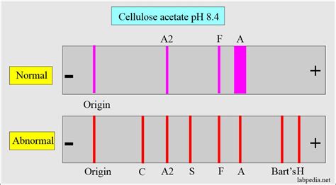 Hemoglobin:- Part 2 - Hemoglobin Electrophoresis, (Hb electrophoresis ...