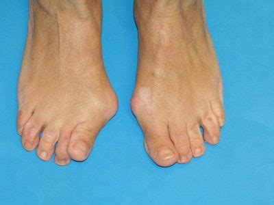 Hallux valgus o Juanete. Qué es, causas, síntomas y tratamiento