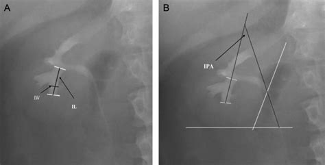 Measurement of the lower-pole calyceal anatomy. (A) Infundibular width... | Download Scientific ...