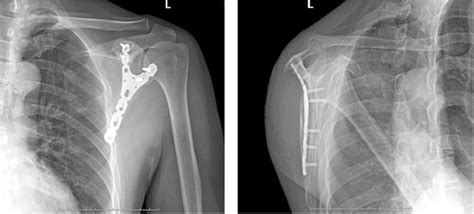 Postoperative scapular X-ray radiographies of the implanted Y-type ...