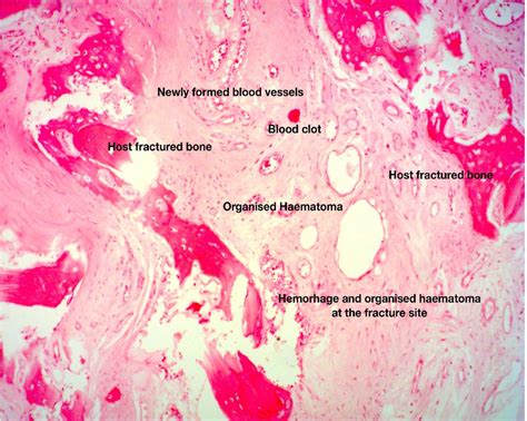 Histologic section of fracture site during the early, fibrous callus ...