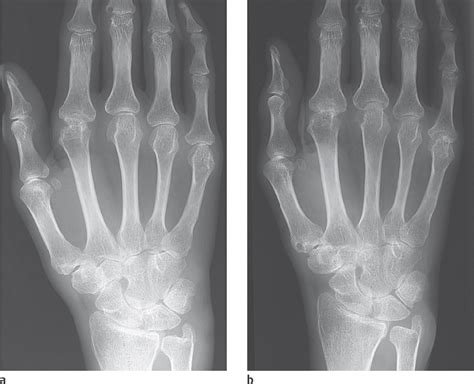 36 Rheumatoid Arthritis | Radiology Key