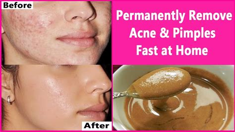 How To Cure Acne Naturally And Permanently - Yeediot