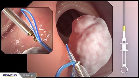 Colonoscopy with polypectomy procedure overview using Olympus devices ...