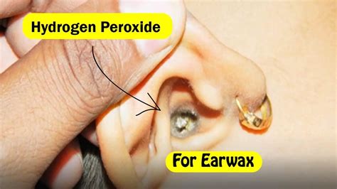 How To Clean Out Ears With Peroxide - Treatbeyond2