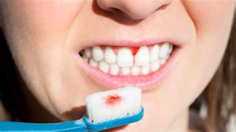 Causes Of Bleeding Gums: How To Stop Gums From Bleeding - Western ...