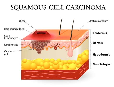 Squamous Cell Carcinoma : Dr Jamie Ryan