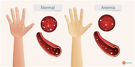 Anemia Rash Symptoms