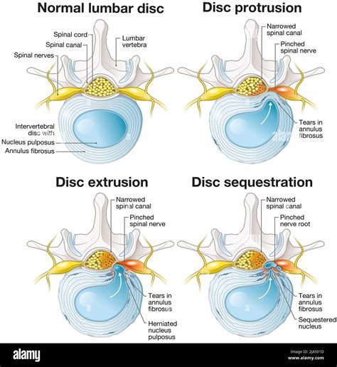 Disc extrusion Cut Out Stock Images & Pictures - Alamy