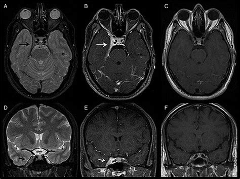 Superior Orbital Fissure Radiology