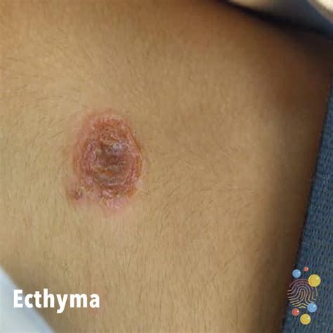 Ecthyma Face