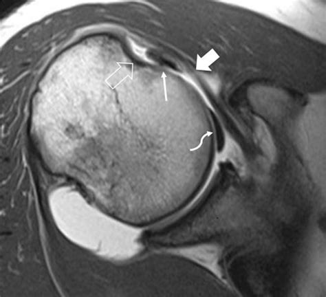 How to read mri images for a torn rotator cuff - alohadelta