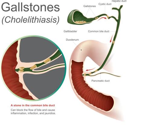 Gall Bladder Surgery - What You Need to Know | Asmark Health