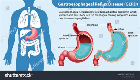 Gastroesophageal Reflux Disease Gerd Diagram Illustration Stock Vector (Royalty Free) 2272413481 ...