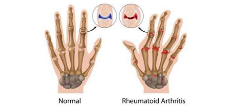 Finger Joint Pain - Symptoms, Causes, Treatments & More