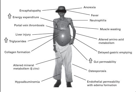 Figure 1 from Treatment of alcoholic liver disease | Semantic Scholar