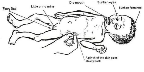 Signs of dehydration in infant | Sunken eyes, Sick kids, Nursing tips