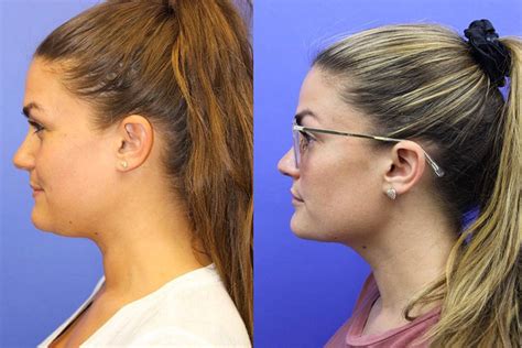 Brittany Cartwright Gets Rid of Double Chin with Kybella Injections, No ...