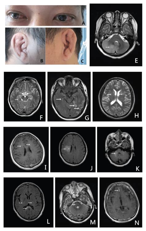 Relapsing Polychondritis with Central Nervous System Involvement Presented as Encephalitis: 7 ...