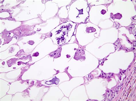 Fat Necrosis Histology