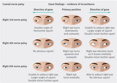 Cranial Nerve Eye Palsy