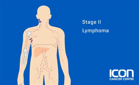 What is Lymphoma? Lymphoma Explained | Icon Cancer Centre