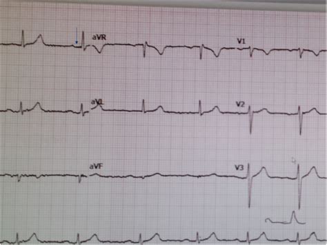 First case report of inducible heart block in Lyme disease and an update of Lyme carditis | BMC ...