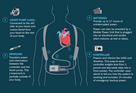 Left Ventricular Assist Device (LVAD): Giving Life - Murmurs | NHCS