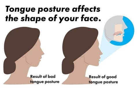 tongue posture effects on mandible - Apex Dental. Dentist Des Moines Iowa