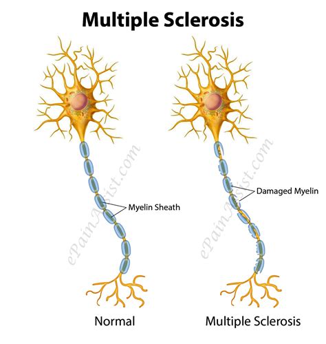 Multiple Sclerosis or Disseminated Sclerosis|Types|Risk Factors|Symptoms|Treatment