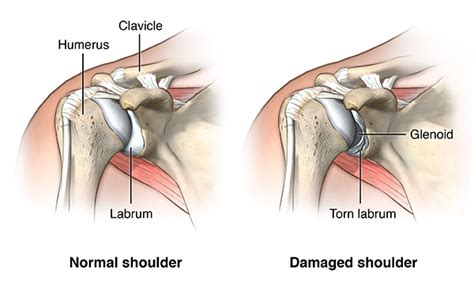 Shoulder Dislocation - Comprehensive Orthopaedics