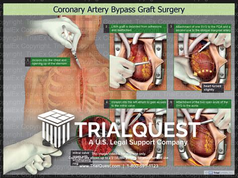 Coronary Artery Bypass Graft Surgry - TrialQuest Inc.