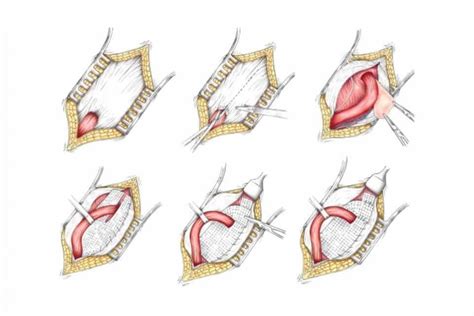 FAQ on Traditional Hernia Repair Surgery with Mesh