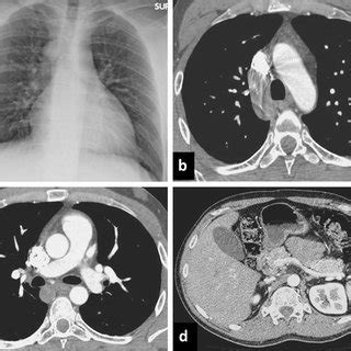 CT of the normal azygos venous system. Contrast-enhanced CT axial... | Download Scientific Diagram