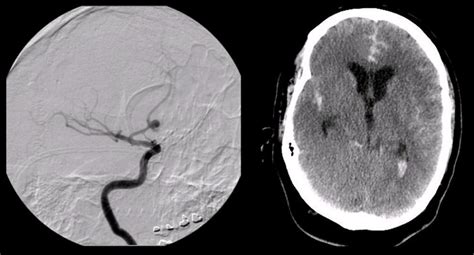 Subarachnoid HemorrhageAcomm